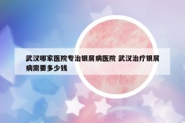 武漢哪家醫(yī)院專治銀屑病醫(yī)院 武漢治療銀屑病需要多少錢