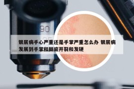 銀屑病手心嚴(yán)重還是手掌嚴(yán)重怎么辦 銀屑病發(fā)展到手掌和腳底開裂和發(fā)硬
