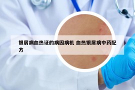 銀屑病血熱證的病因病機 血熱銀屑病中藥配方