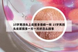 15歲男孩頭上皮屑多像癬一樣 15歲男孩頭皮屑很多一片一片的怎么回事