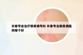 長(zhǎng)春專(zhuān)業(yè)治療銀屑病專(zhuān)科 長(zhǎng)春專(zhuān)治銀屑病醫(yī)院哪個(gè)好