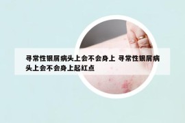 尋常性銀屑病頭上會不會身上 尋常性銀屑病頭上會不會身上起紅點