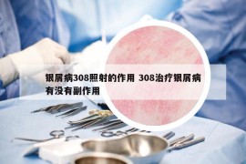 銀屑病308照射的作用 308治療銀屑病有沒有副作用