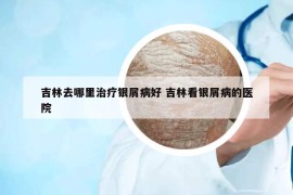 吉林去哪里治療銀屑病好 吉林看銀屑病的醫(yī)院