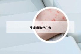 牛皮癬治療廣告