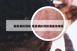 銀屑病的預(yù)防 銀屑病的預(yù)防措施有哪些