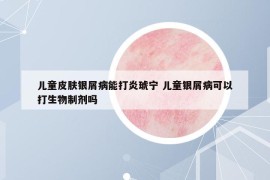 兒童皮膚銀屑病能打炎琥寧 兒童銀屑病可以打生物制劑嗎