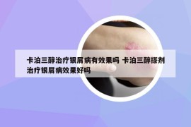 卡泊三醇治療銀屑病有效果嗎 卡泊三醇搽劑治療銀屑病效果好嗎