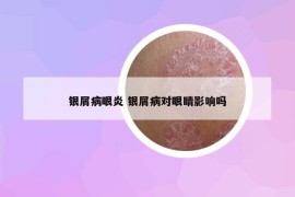 銀屑病眼炎 銀屑病對眼睛影響嗎