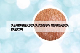 頭部銀屑病洗完頭頭皮會亮嗎 銀屑病洗完頭都是紅斑