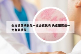 頭皮銀屑病頭發(fā)一定會(huì)束狀嗎 頭皮銀屑病一定有束狀發(fā)