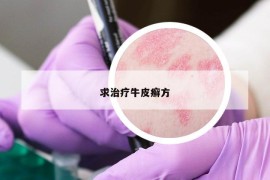 求治療牛皮癬方