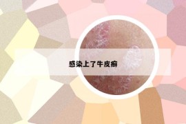 感染上了牛皮癬