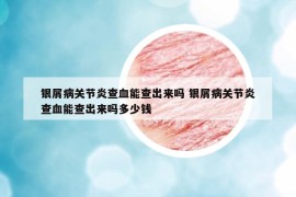 銀屑病關(guān)節(jié)炎查血能查出來嗎 銀屑病關(guān)節(jié)炎查血能查出來嗎多少錢