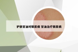 護膚甘油對銀屑病 甘油治療銀屑病