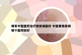 哪家中醫(yī)醫(yī)院治療銀屑病最好 中醫(yī)看銀屑病哪個(gè)醫(yī)院較好