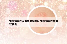 銀屑病能吃深海魚油膠囊嗎 銀屑病能吃魚油軟膠囊