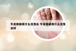 牛皮膚癬用什么洗發(fā)水 牛皮膚癬用什么洗發(fā)水好
