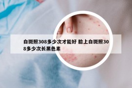 白斑照308多少次才能好 臉上白斑照308多少次長(zhǎng)黑色素