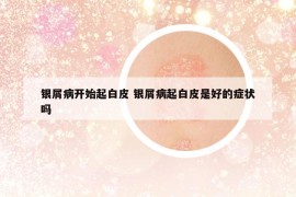 銀屑病開始起白皮 銀屑病起白皮是好的癥狀嗎