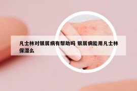 凡士林對(duì)銀屑病有幫助嗎 銀屑病能用凡士林保濕么