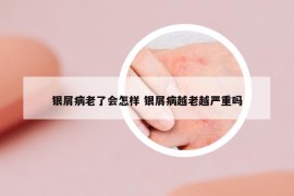 銀屑病老了會怎樣 銀屑病越老越嚴(yán)重嗎