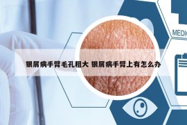 銀屑病手臂毛孔粗大 銀屑病手臂上有怎么辦