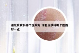 淮北皮膚科哪個(gè)醫(yī)院好 淮北皮膚科哪個(gè)醫(yī)院好一點(diǎn)
