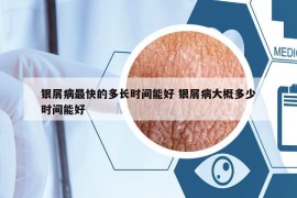 銀屑病最快的多長(zhǎng)時(shí)間能好 銀屑病大概多少時(shí)間能好