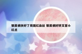 銀屑病快好了周圍紅血絲 銀屑病好轉(zhuǎn)又冒小紅點(diǎn)