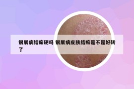銀屑病結(jié)痂硬嗎 銀屑病皮膚結(jié)痂是不是好轉(zhuǎn)了