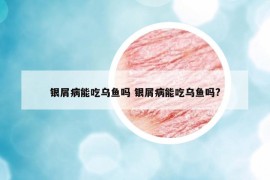 銀屑病能吃烏魚嗎 銀屑病能吃烏魚嗎?