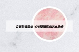 關(guān)節(jié)型銀屑病 關(guān)節(jié)型銀屑病怎么治療