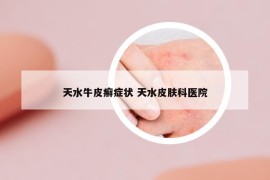 天水牛皮癬癥狀 天水皮膚科醫(yī)院