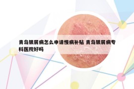 青島銀屑病怎么申請慢病補(bǔ)貼 青島銀屑病?？漆t(yī)院好嗎