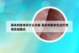 英夫利昔單抗什么價格 英夫利西單抗治療潰瘍性結(jié)腸炎