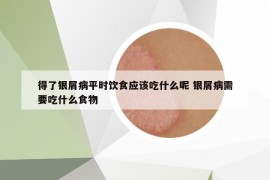 得了銀屑病平時(shí)飲食應(yīng)該吃什么呢 銀屑病需要吃什么食物