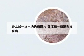 身上長一塊一塊的癬圖片 百度掃一掃識別皮膚病