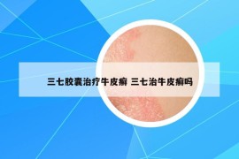 三七膠囊治療牛皮癬 三七治牛皮癬嗎