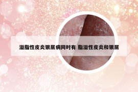 溢脂性皮炎銀屑病同時(shí)有 脂溢性皮炎和銀屑