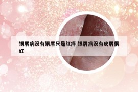 銀屑病沒(méi)有銀屑只是紅癢 銀屑病沒(méi)有皮屑很紅