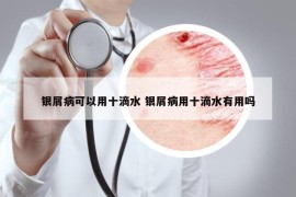 銀屑病可以用十滴水 銀屑病用十滴水有用嗎