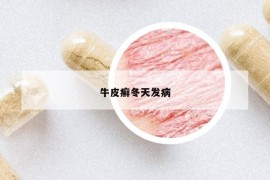 牛皮癬冬天發(fā)病