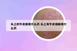 頭上的牛皮癬用什么藥 頭上有牛皮病癬用什么藥