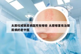 太原權(quán)威銀屑病醫(yī)院有哪些 太原哪里有治銀屑病的老中醫(yī)
