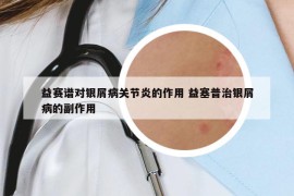益賽譜對銀屑病關節(jié)炎的作用 益塞普治銀屑病的副作用