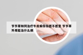 節(jié)節(jié)草如何治療牛皮癬你你愿不愿意 節(jié)節(jié)草外用能治什么病