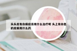 頭頭皮有白癬應(yīng)該用什么治療呢 頭上有白色的皮癬用什么藥