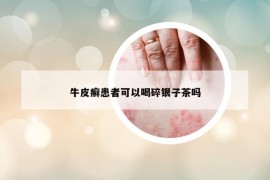 牛皮癬患者可以喝碎銀子茶嗎