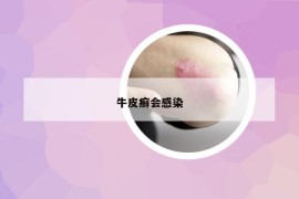 牛皮癬會感染